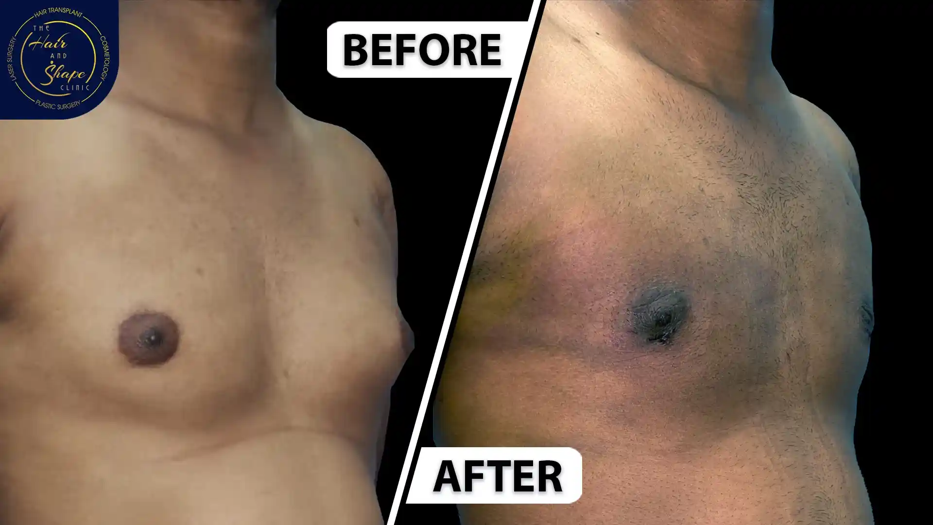 Gynecomastia result4